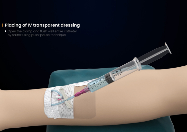 Wizualizacja 3D procedury medycznej IV dressing cewnik Sol-Millennium animacja kliniczna